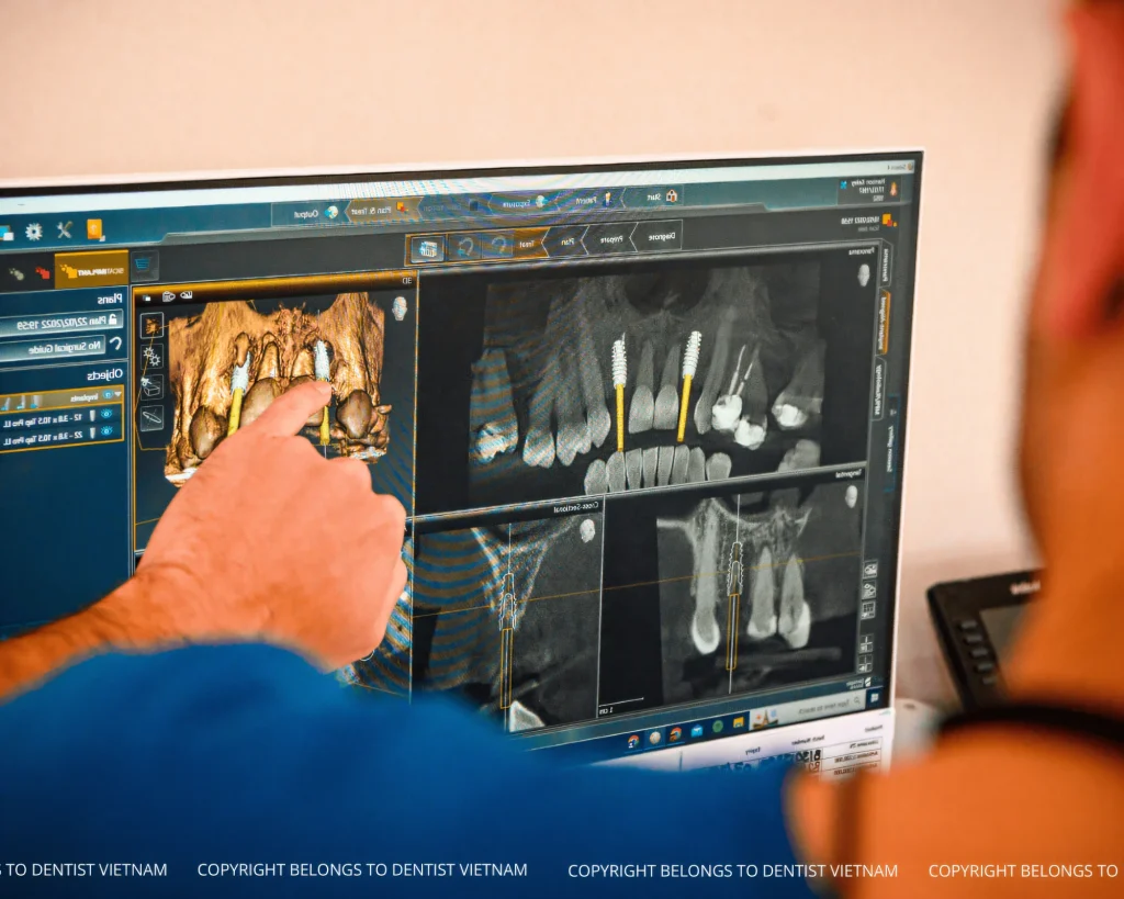 step by step procedure for all on 4 dental implants