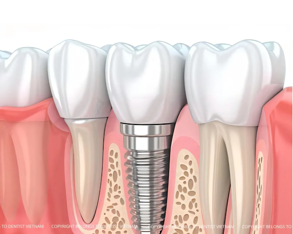 all on 4 dental implants process