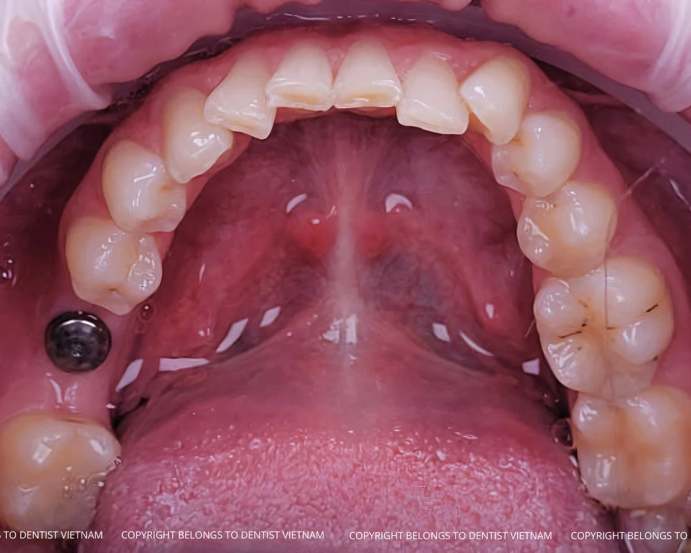 all on four dental implants procedure