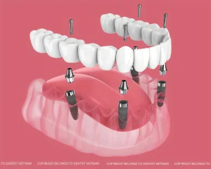 Cheap dental implants near me: Best low cost options in Vietnam 2026