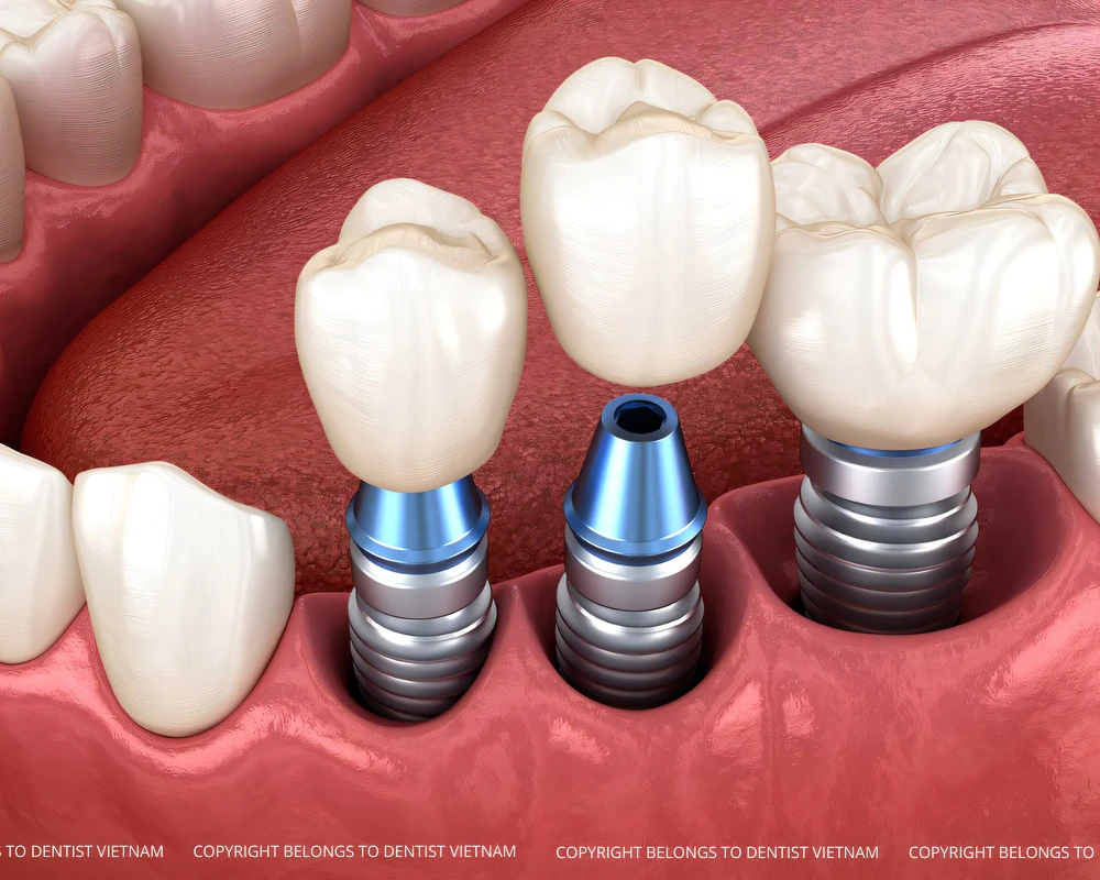 low cost dental implants near me