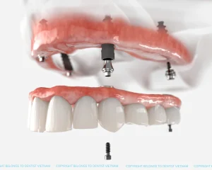Best country for dental tourism 2026: Top destinations in the world