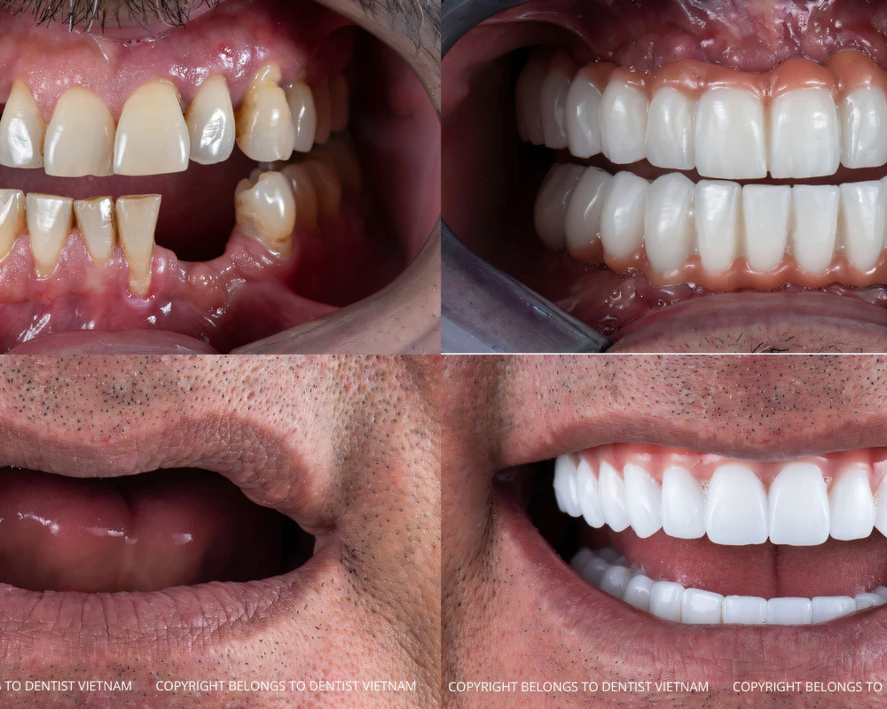 cost permanent full dental implants