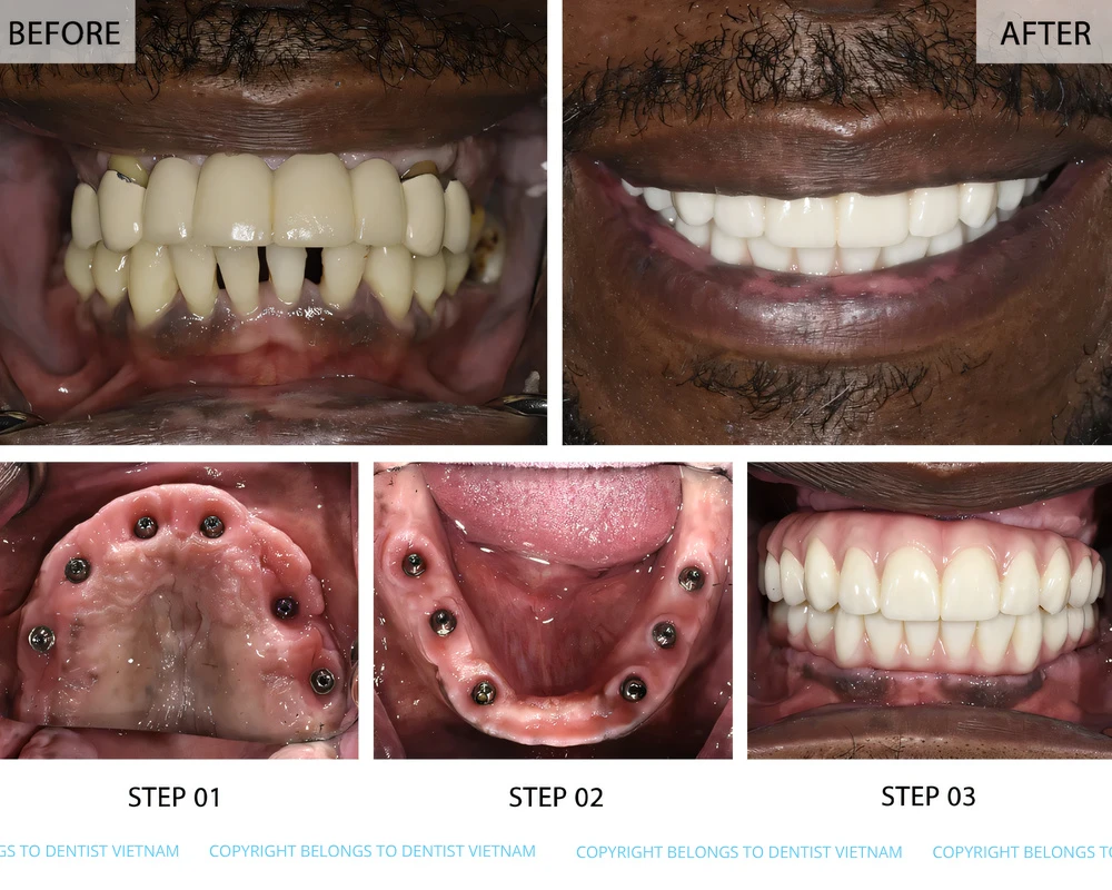 cheap dental implants near me
