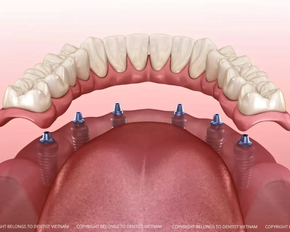 permanent full mouth dental implants