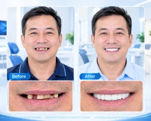 Your 2026 guide to dental tourism Vietnam – Treatment and costs