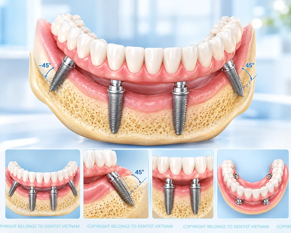 same day all on 4 dental implants