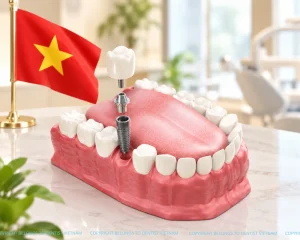 All on 6 dental implants: Benefits, costs and recovery